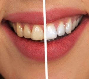 Weiße Zähne Vergleich