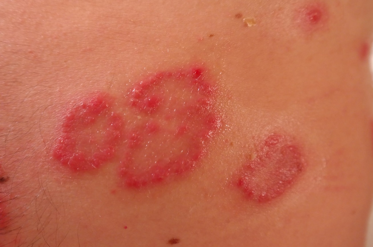 【ᐅᐅ】Gürtelrose Symptome &amp; Behandlung Die besten Tipps!